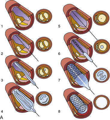 Illustration of Percutaneous Coronary Intervention PCI Procedure Indications Risks And Management symptoms