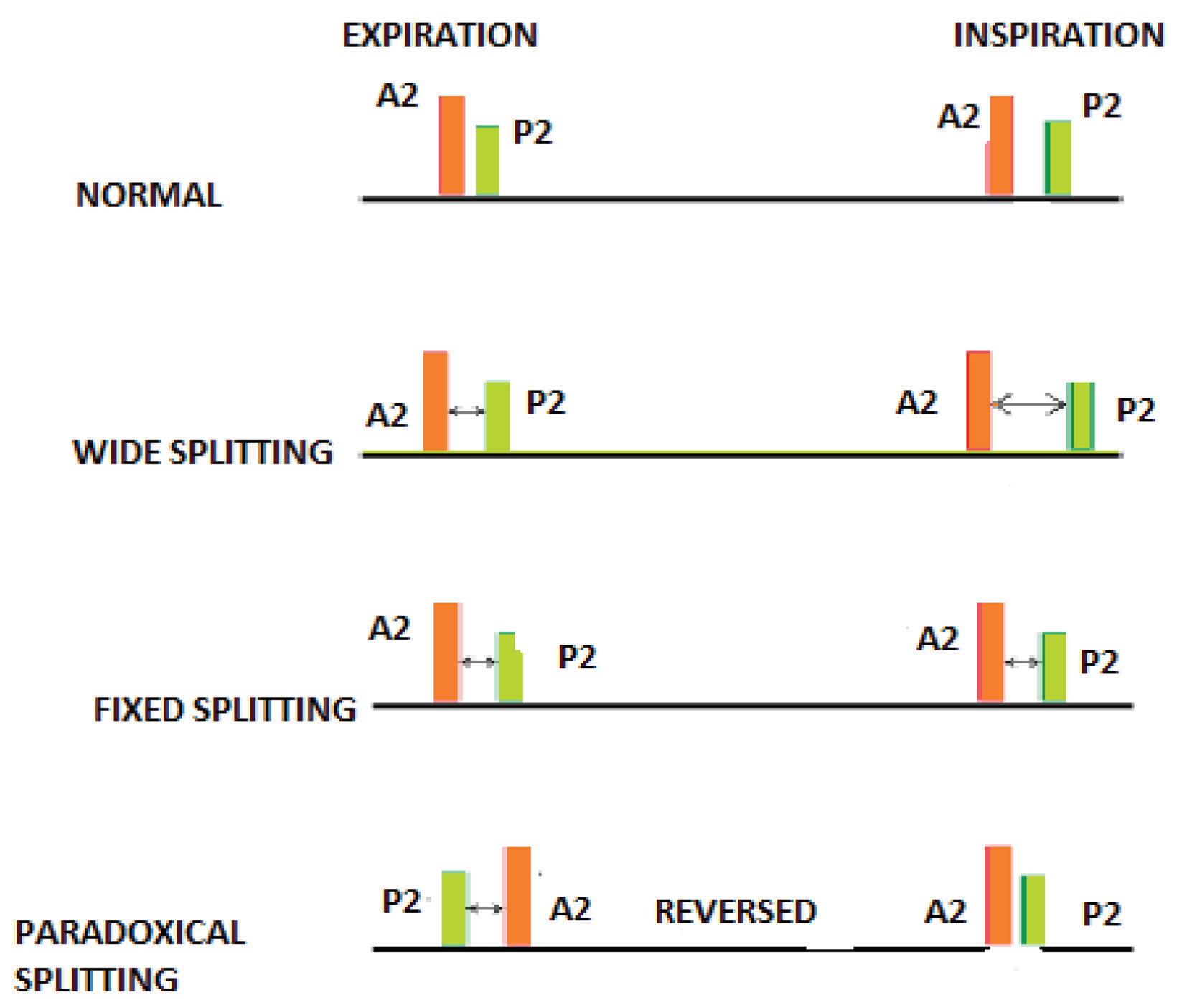 Illustration of Second Heart Sound S2 Clinical Features Physiology Splitting and Causes symptoms