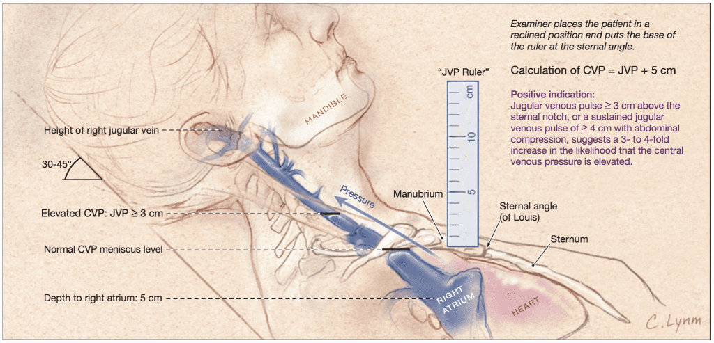 Illustration of First Heart Sound S1 and Jugular Venous Pulse JVP Clinical Examination Guide symptoms