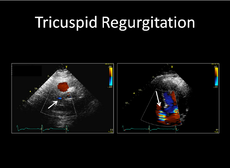 Illustration of Tricuspid Regurgitation Causes Symptoms Diagnosis Management Explained symptoms