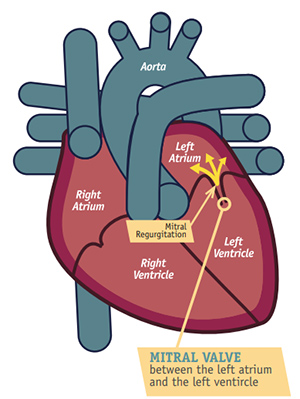 Illustration of Mitral Regurgitation Detailed Management Guidelines Diagnosis and Treatment symptoms