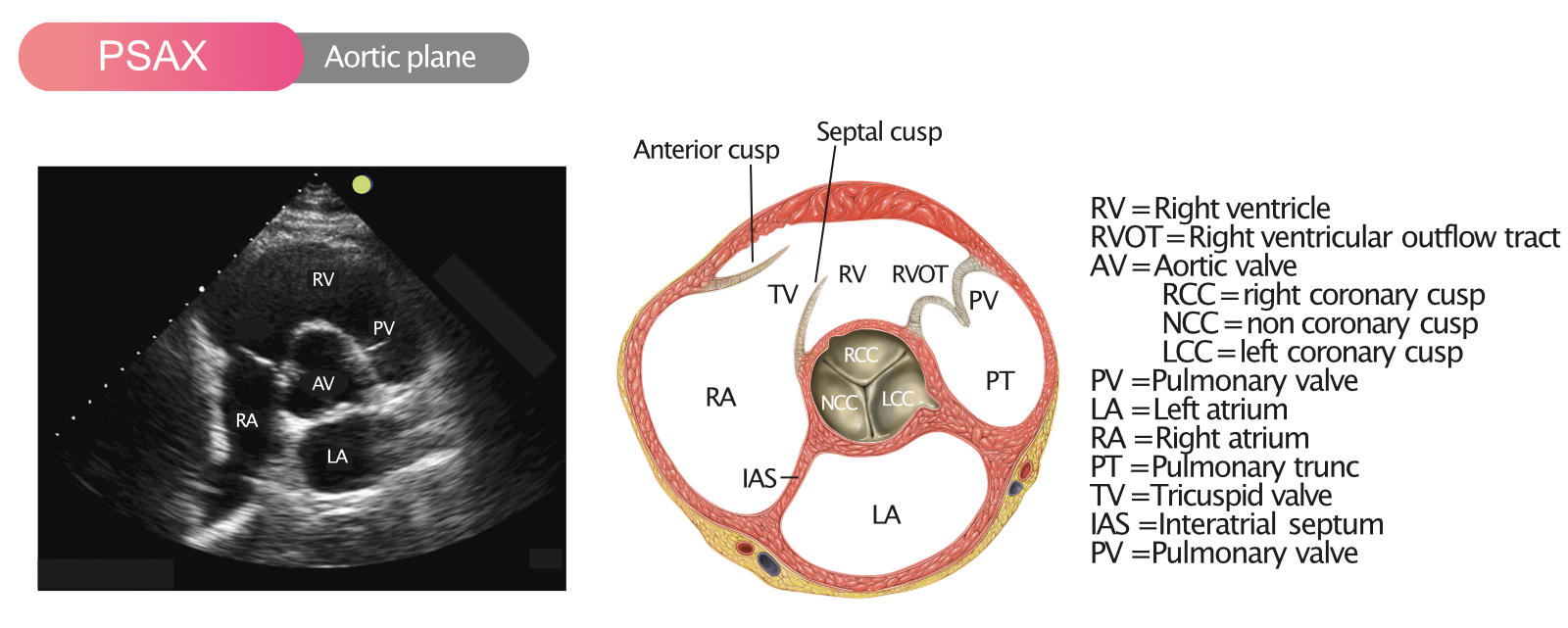Illustration of Aortic Stenosis Complete Clinical Guide Causes Symptoms Diagnosis Treatment symptoms
