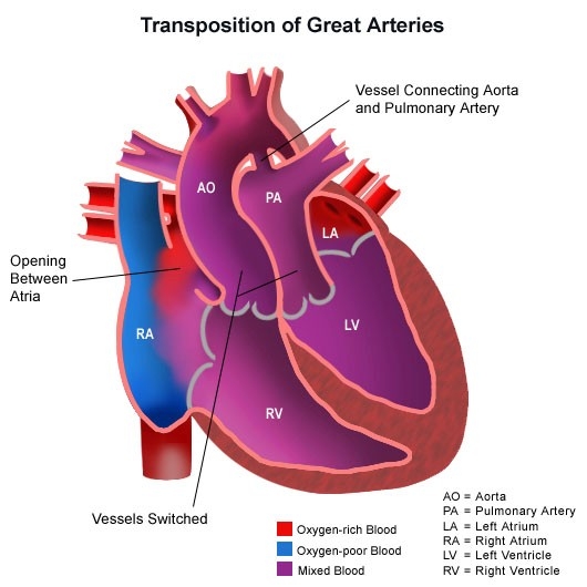 Illustration of Congenital Heart Disease Complete Guide Causes Types Diagnosis and Treatment symptoms