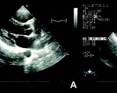 Illustration of Rheumatic Heart Disease Clinical Features Diagnosis Management and Prevention symptoms