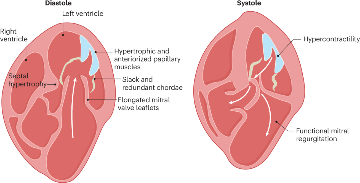 Illustration of Cardiomyopathies Clinical Types Diagnosis and Management Guide symptoms