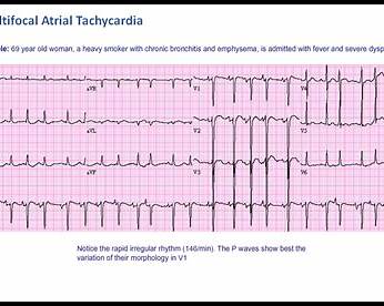 Illustration of Multifocal Atrial Tachycardia Clinical Features ECG Diagnosis and Management symptoms