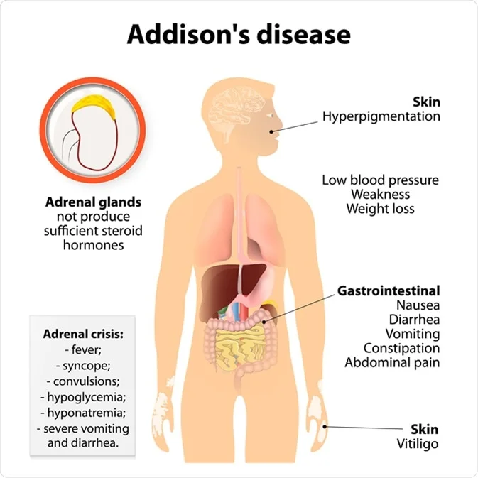 Illustration of Addison’s Disease Comprehensive Clinical Guide Diagnosis Causes and Management symptoms