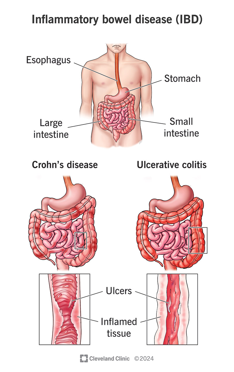 Illustration of Crohn’s Disease Complete Guide Causes Symptoms Diagnosis and Treatment symptoms