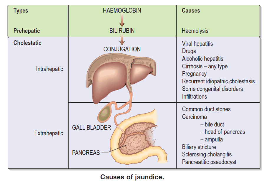 Illustration of Differential Diagnosis of Jaundice Complete Causes Types Clinical Approach symptoms